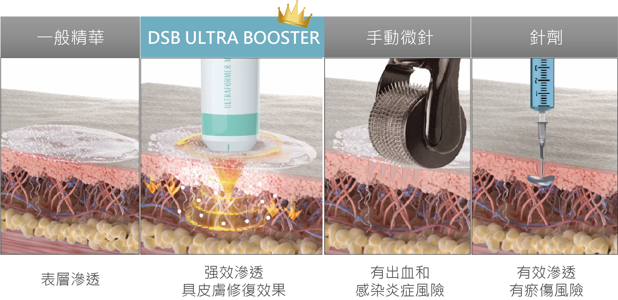 針劑有效滲透 有瘀傷風險。手動微針有出血和感染炎症風險。DSB ULTRA BOOSTER强效滲透，具皮膚修復效果。一般精華表層滲透針。